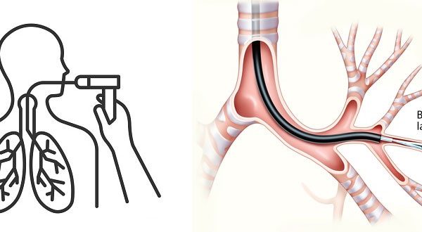 برونکوسکوپی و شستشوی ریه در اصفهان