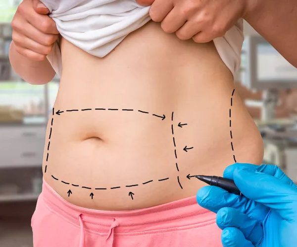 لیپولیز در اصفهان