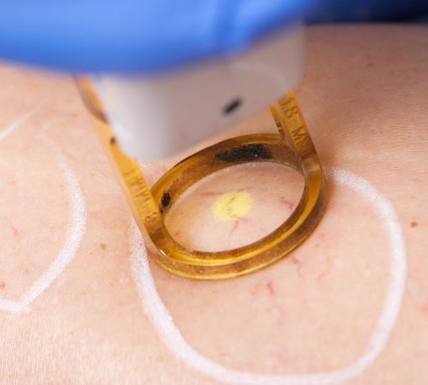 درمان واریس در اصفهان