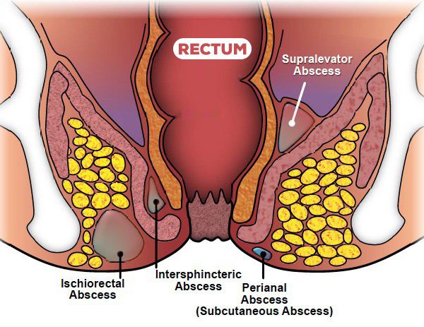 لیزر آبسه مقعد