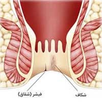 درمان فیشر در اصفهان