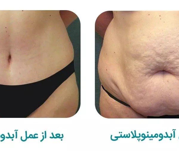 لیپوماتیک در اصفهان