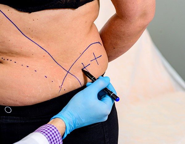 لیپوساکشن در اصفهان