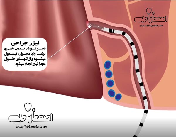 لیزر فیستول