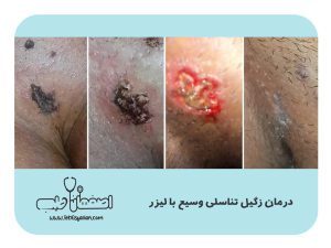 Genital-Wart-Removal-in-Isfahan-Definitive-Treatment