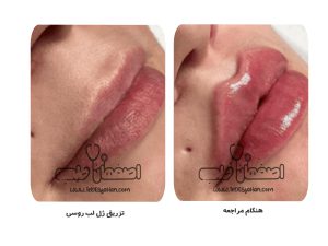 تزریق ژل و فیلر لب