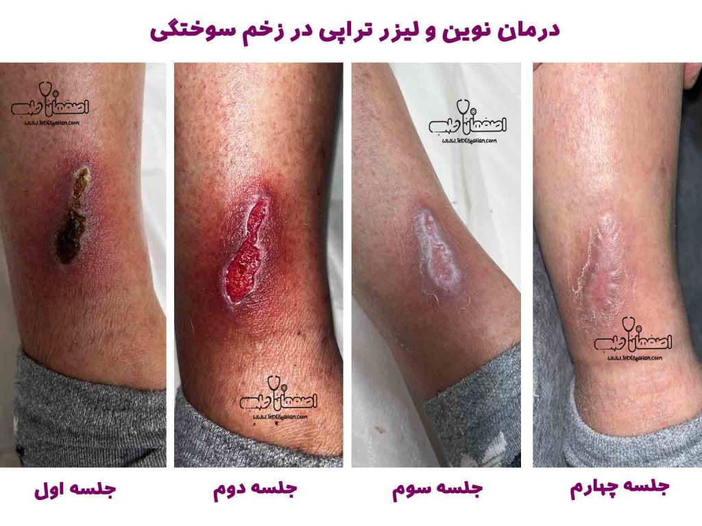 درمان سوختگی در اصفهان