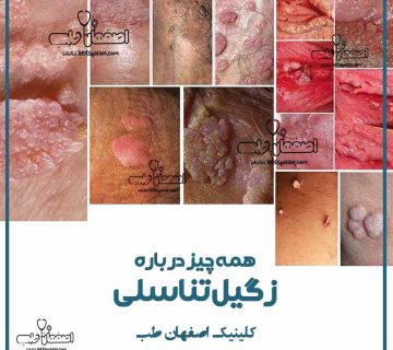 درمان لیزری زگیل تناسلی