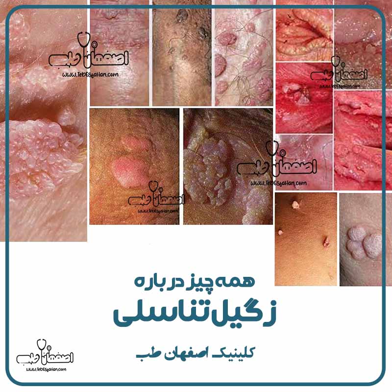 درمان لیزری زگیل تناسلی