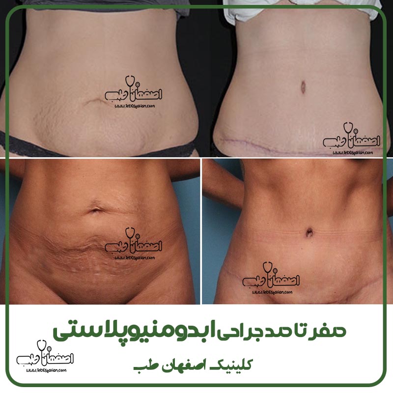 صفرتاصد جراحی ابدومینوپلاستی