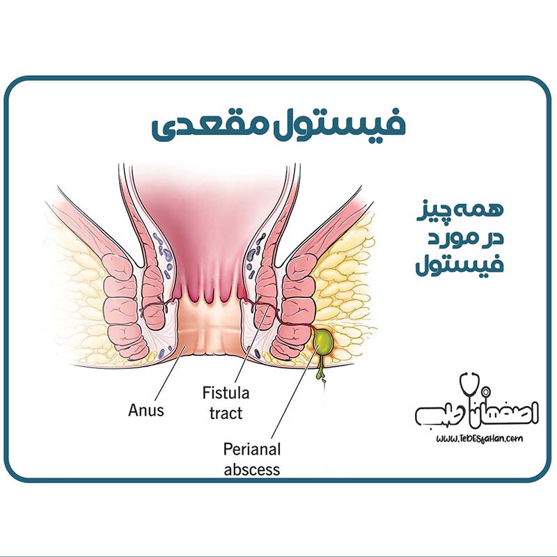 فیستول مقعدی چیست