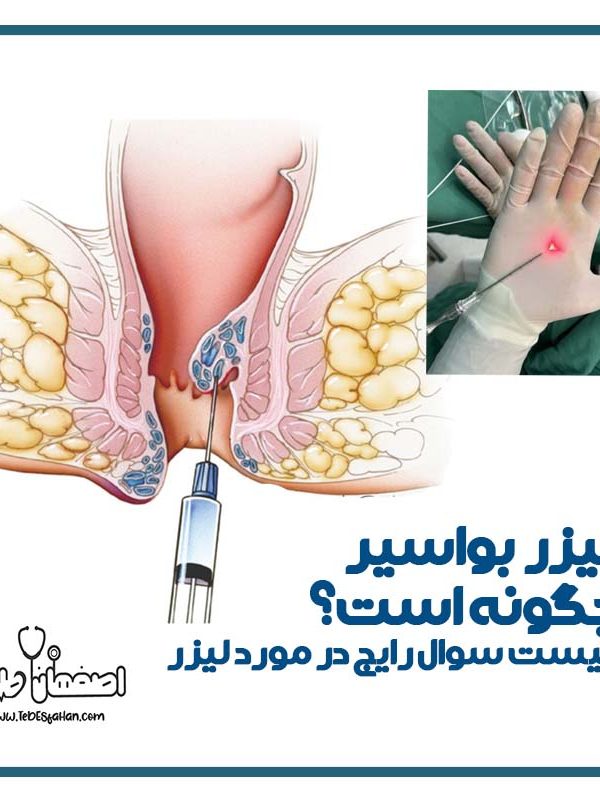 لیزر بواسیر چگونه انجام میشود