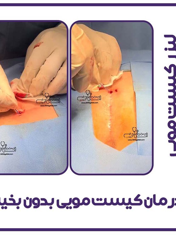 درمان سرپایی کیست مویی