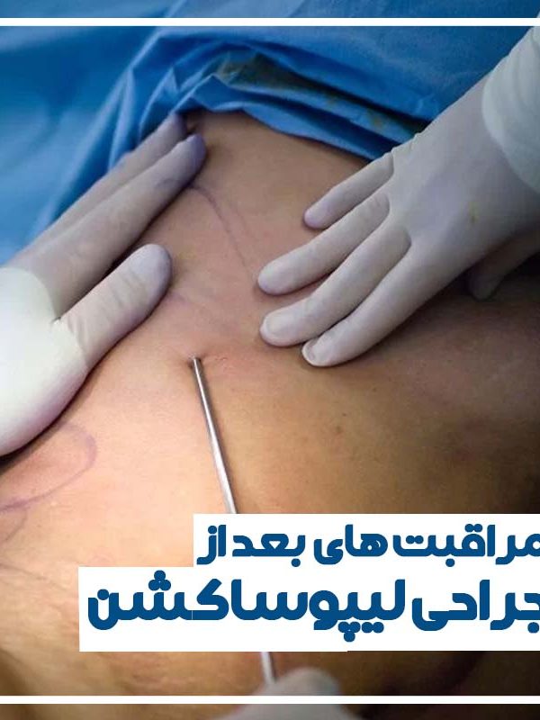لیپوساکشن