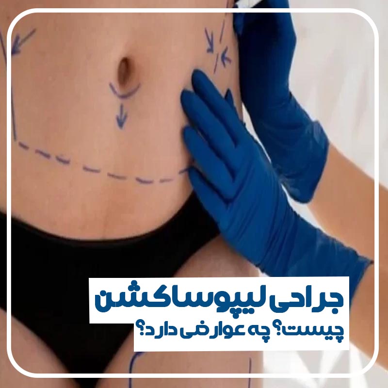 لیپوساکشن چیست