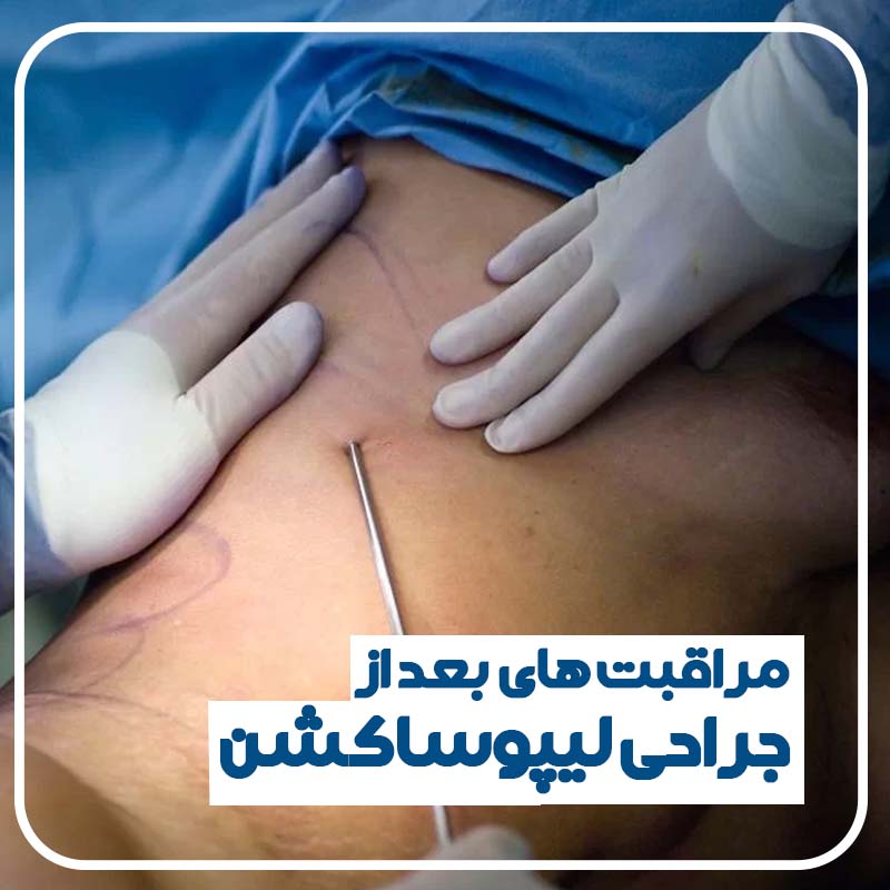 لیپوساکشن
