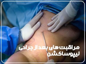 مراقبت های پس از جراحی لیپوساکشن