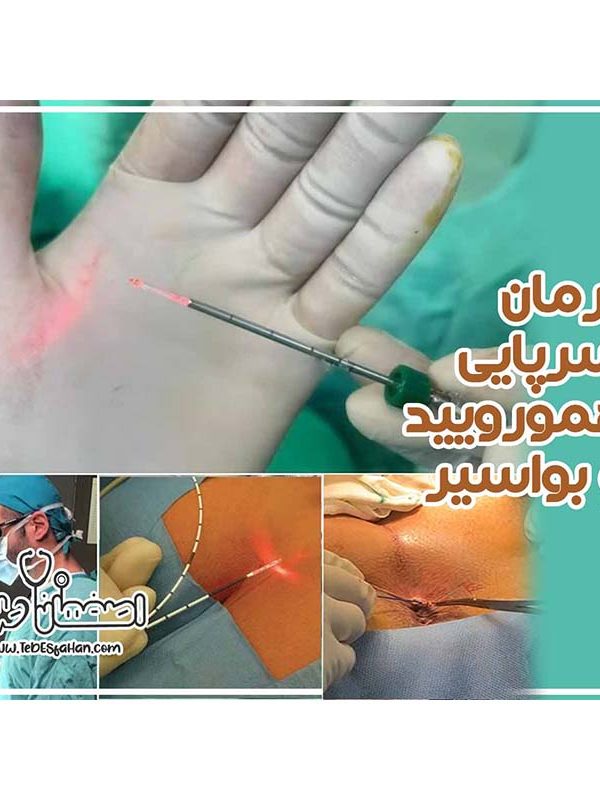 درمان سرپایی بواسیر