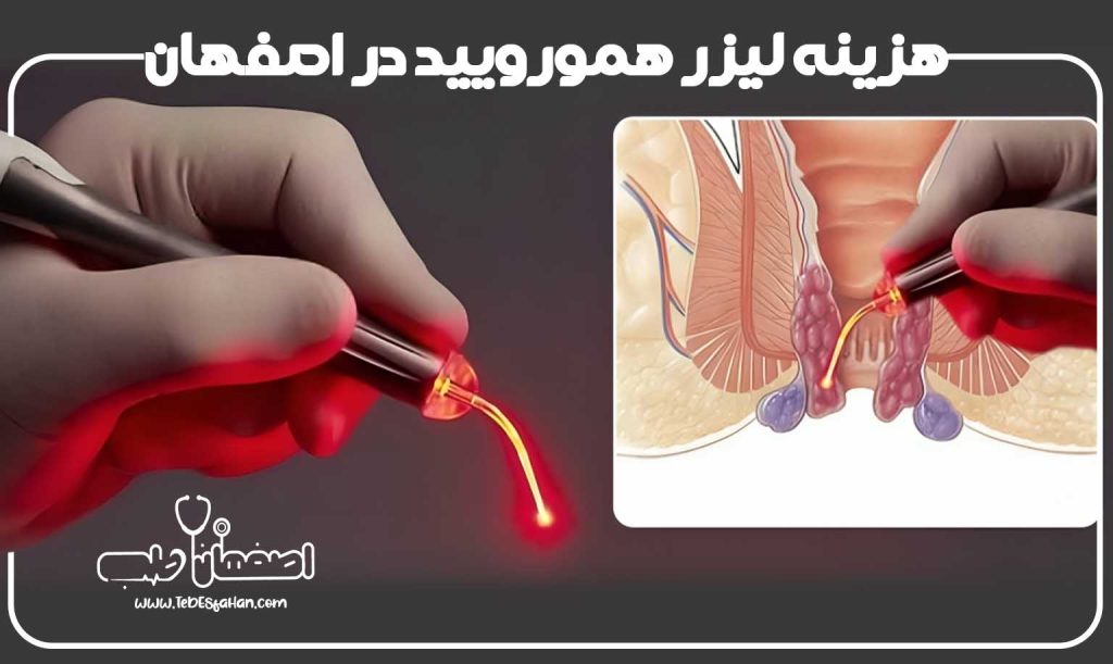 هزینه لیزر بواسیر