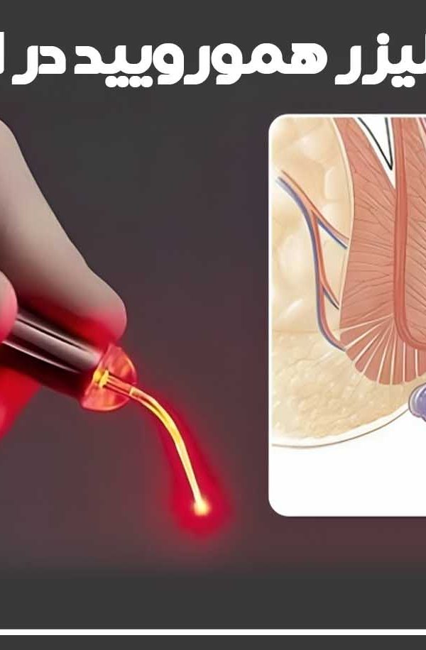 هزینه لیزر بواسیر