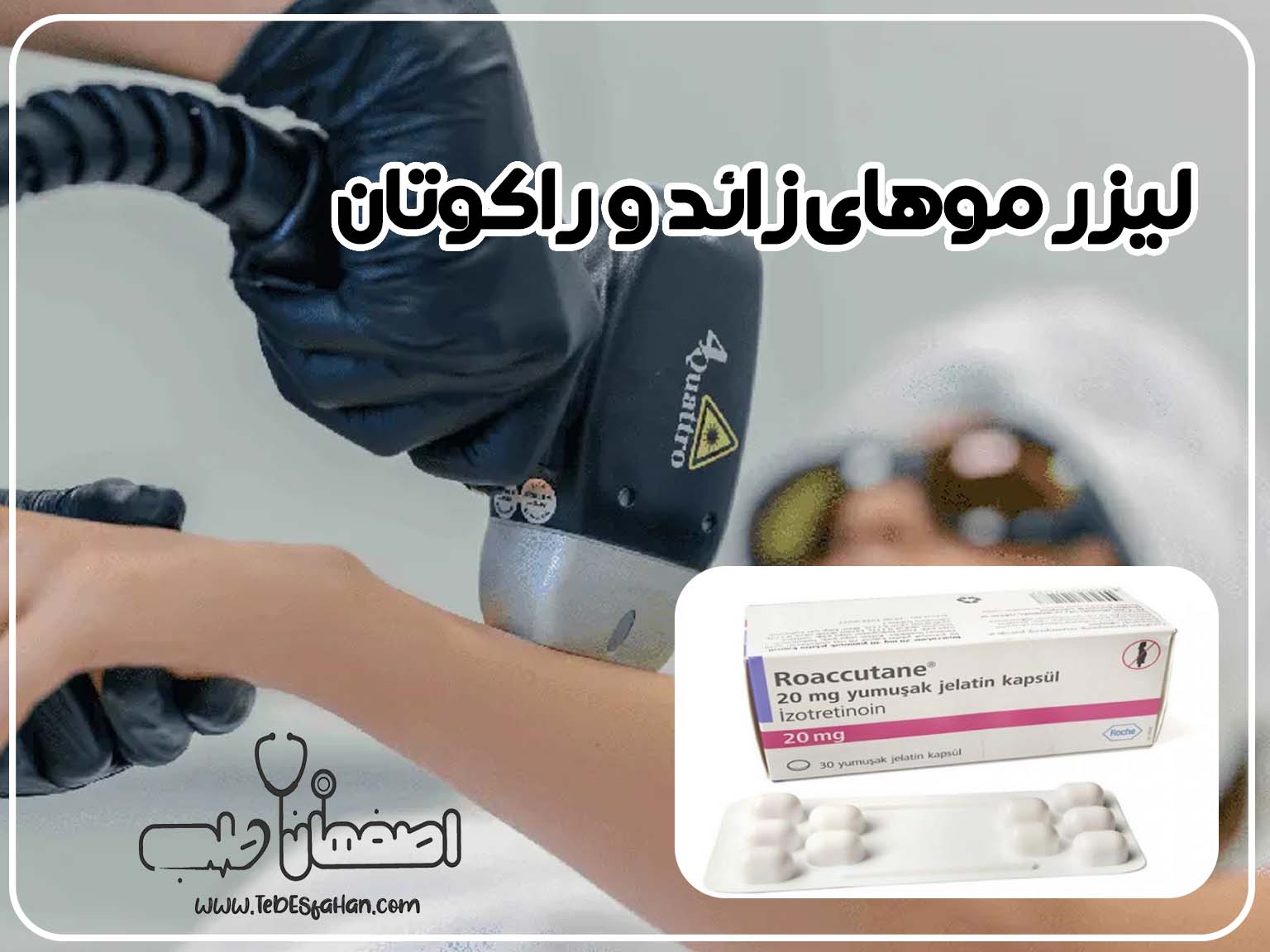 لیزر موهای زائد حین مصرف راکوتان