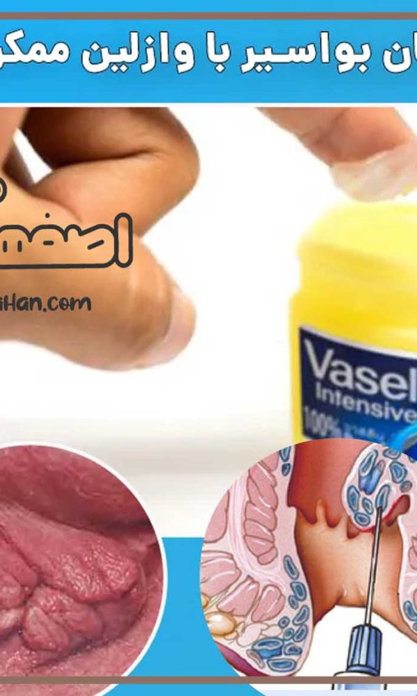 درمان همورویید با وازلین در منزل