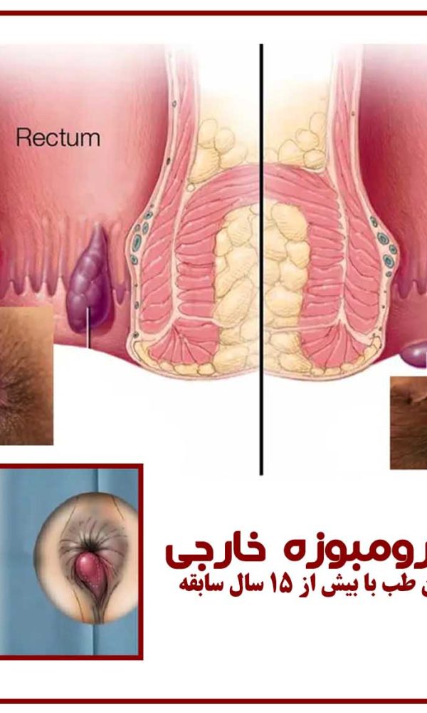 هموروئید ترومبوزه خارجی