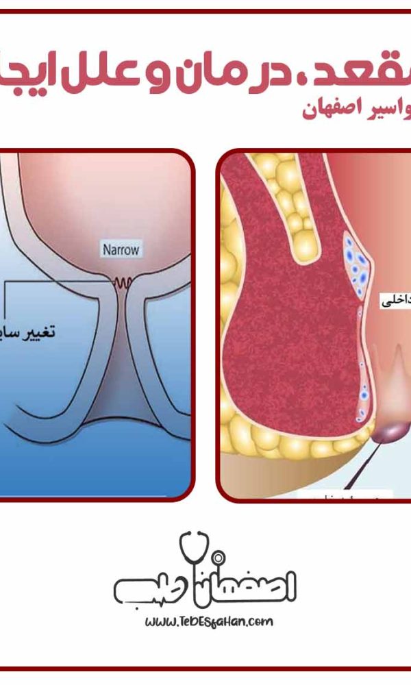 گشادی مقعد و درمان آن | کلینیک اصفهان طب