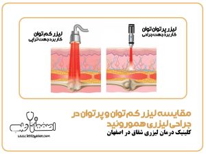 مقایسه لیزر کم‌ توان و پرتوان در جراحی لیزری هموروئید