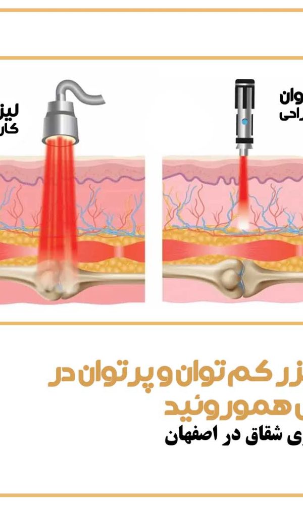 مقایسه لیزر کم‌ توان و پرتوان در جراحی لیزری هموروئید
