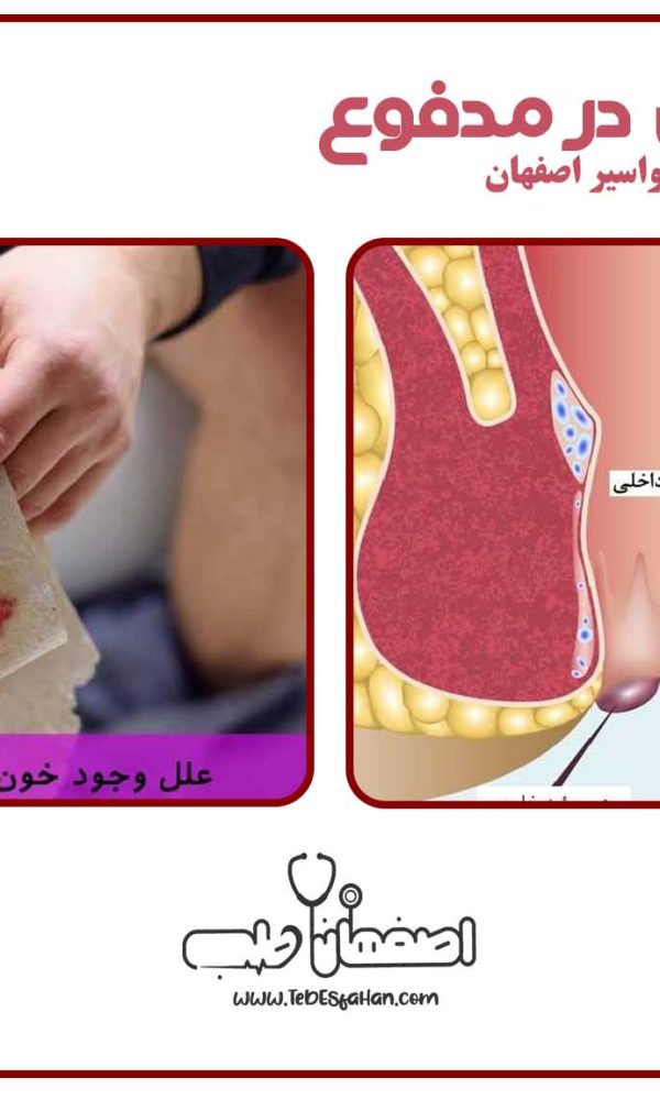 وجود خون در مدفوع