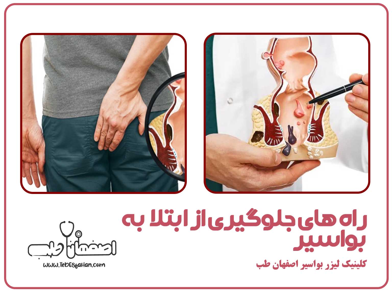 راه های جلوگیری از ابتلا به بواسیر