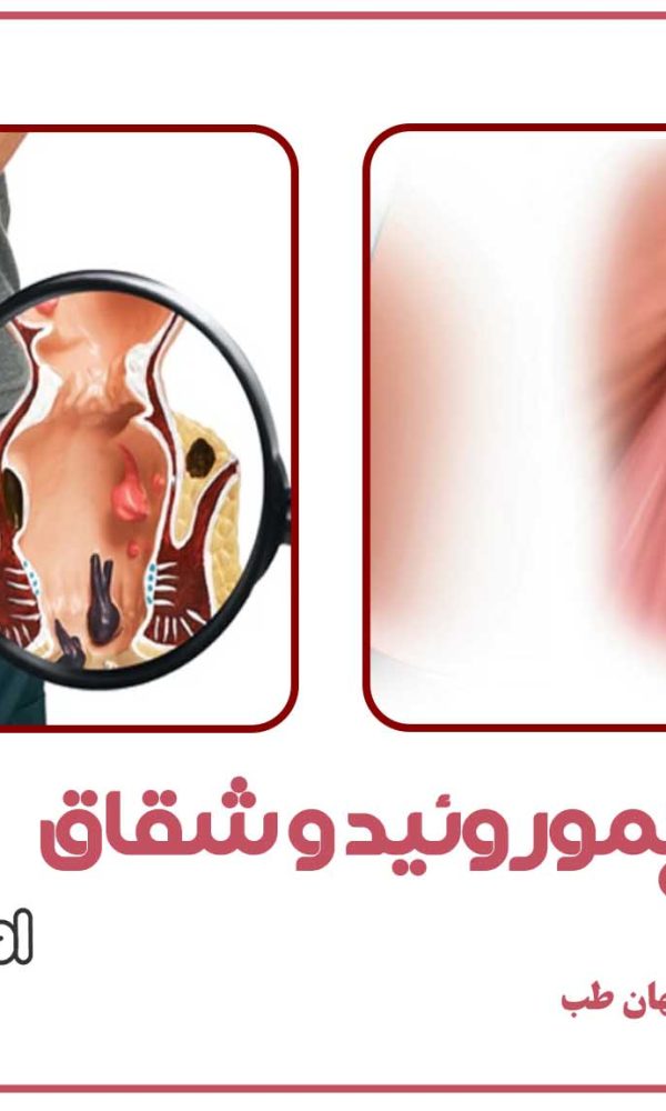 تفاوت هموروئید و شقاق چیست؟