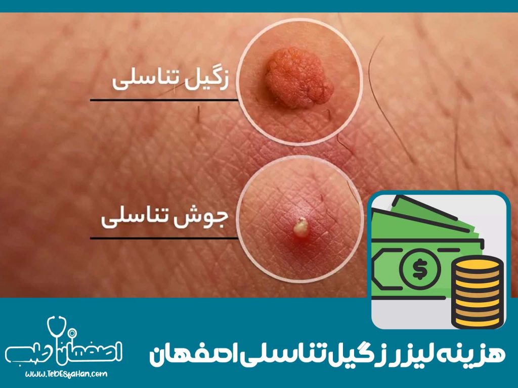 هزینه لیزر زگیل تناسلی در اصفهان