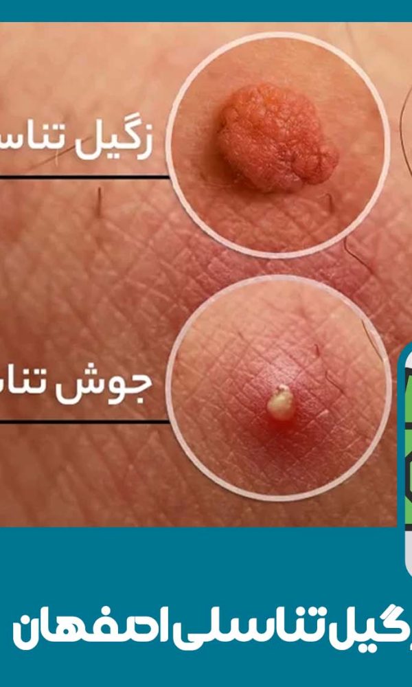 هزینه لیزر زگیل تناسلی در اصفهان