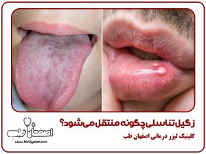 زگیل تناسلی چگونه منتقل میشود