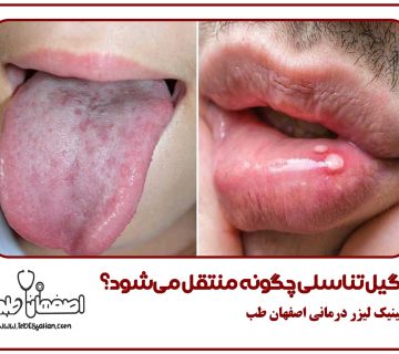 زگیل تناسلی چگونه منتقل میشود