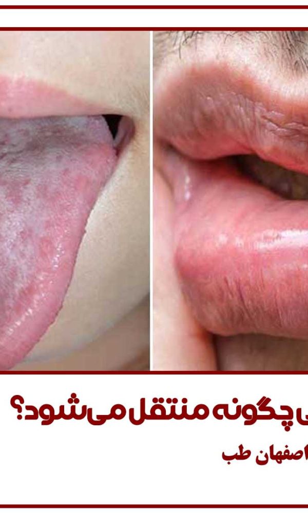 زگیل تناسلی چگونه منتقل میشود