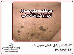 مراقبت های بعد از لیزر زگیل تناسلی اصفهان