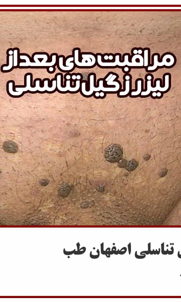 مراقبت های بعد از لیزر زگیل تناسلی اصفهان