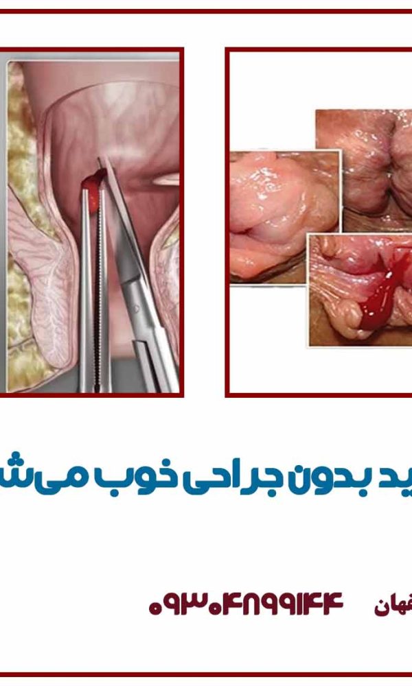 آیا هموروئید بدون جراحی خوب می‌شود؟