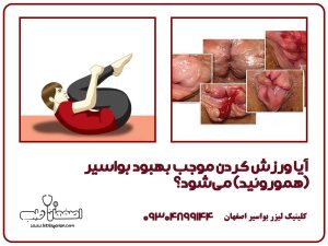 آیا ورزش کردن باعث بهبود بواسیر (هموروئید) می شود؟