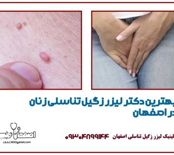 بهترین دکتر لیزر زگیل تناسلی زنان در اصفهان