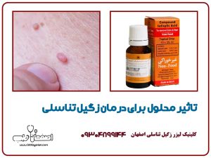 تاثیر محلول برای درمان زگیل تناسلی