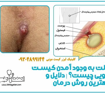 علت به وجود آمدن کیست مویی چیست؟ | دلایل و بهترین روش درمان