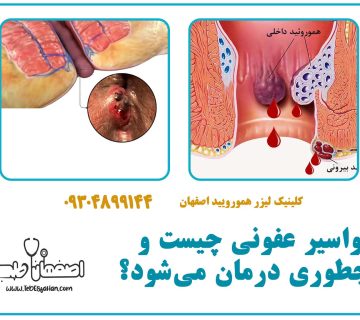 بواسیر عفونی چیست و چطوری درمان می‌شود؟