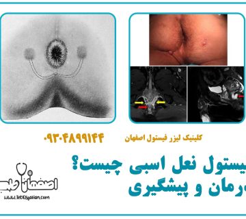 فیستول نعل اسبی چیست؟ درمان و پیشگیری  کلینیک اصفهان طب