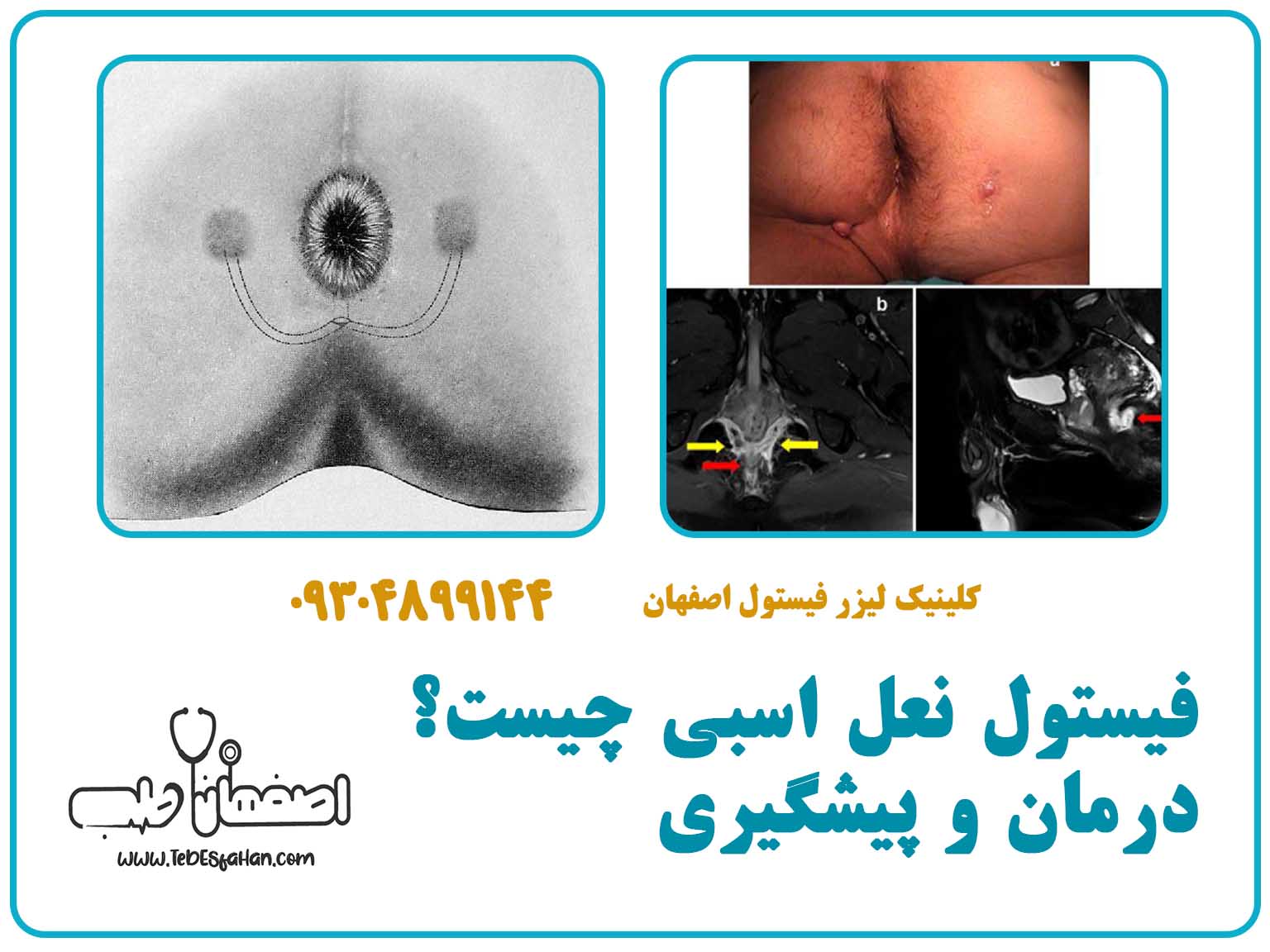 فیستول نعل اسبی چیست؟ درمان و پیشگیری کلینیک اصفهان طب