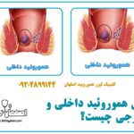 فرق هموروئید داخلی و خارجی چیست؟