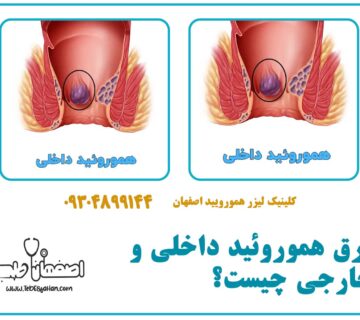 فرق هموروئید داخلی و خارجی چیست؟